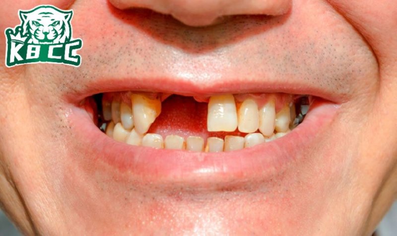 Mơ gãy răng cửa trên báo hiệu bạn phải cẩn trọng